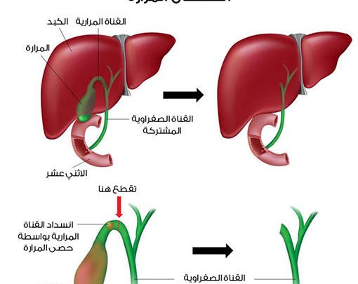 أعراض حصوة المرارة قائمة بأهمها صحتي هنا
