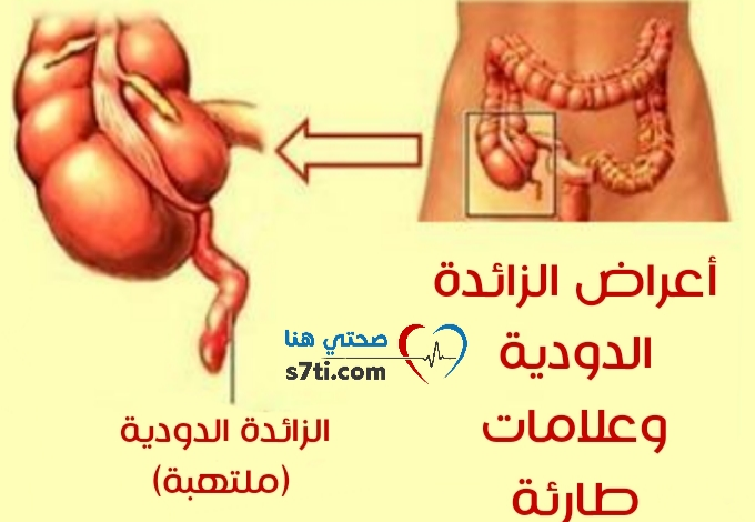 أعراض الزائدة الدودية وعلامات طارئة صحتي هنا