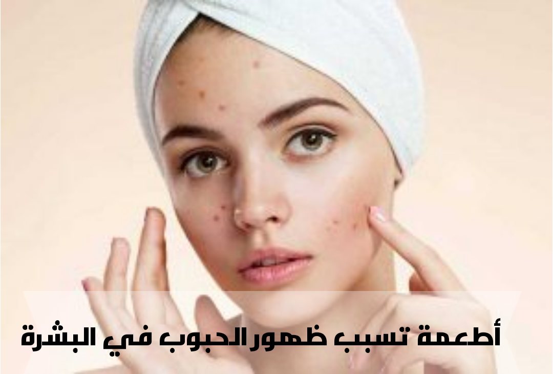 أطعمة تسبب ظهور الحبوب في البشرة صحتي هنا 3986