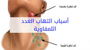 أسباب تورم الغدد اللمفاوية صحتي هنا