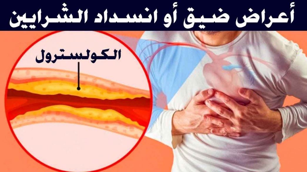 أعراض انسداد شرايين القلب صحتي هنا